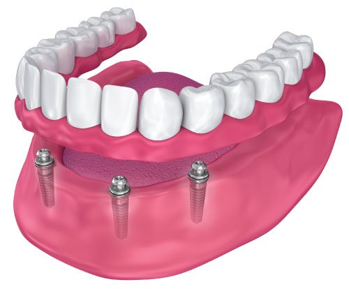 Dentures