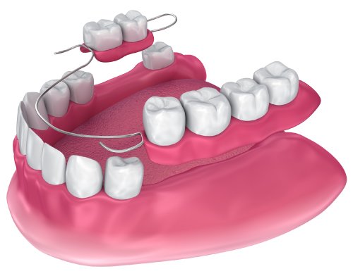 Partial DENTURES
