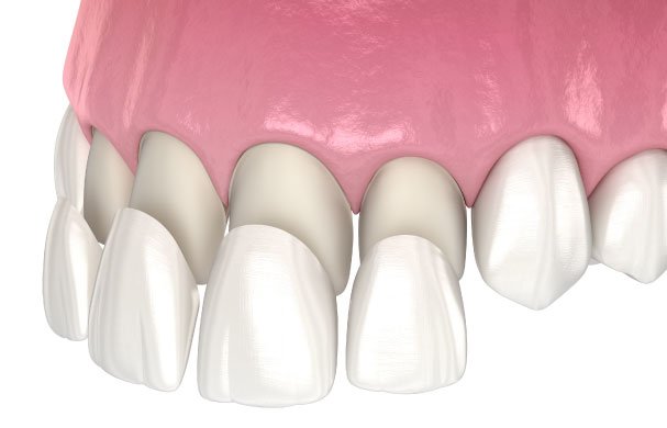 Porcelain Veneers