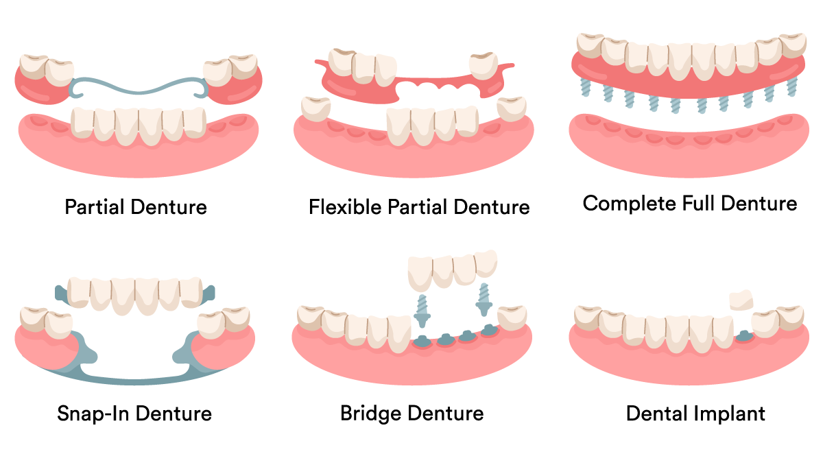 Types of dentures