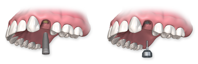Dental Implant Procedure
