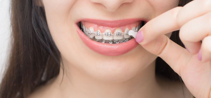 Orthodontic Wax