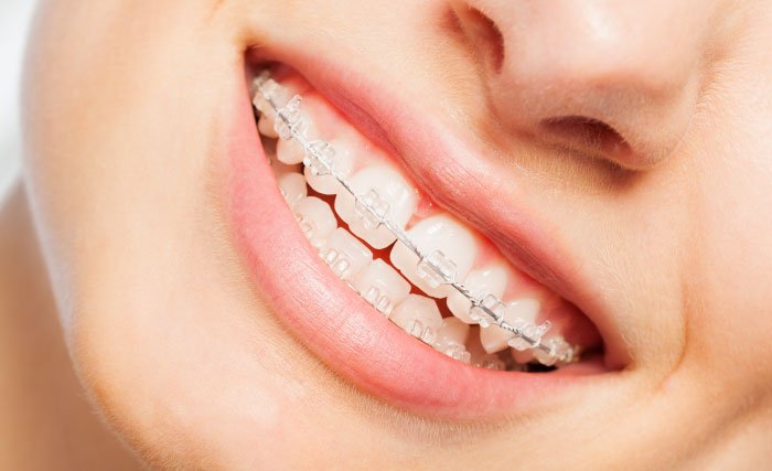 Clear Braces